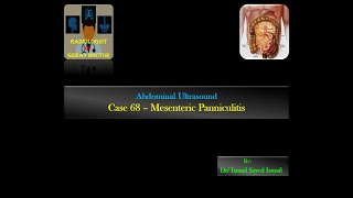 Ultrasound Case 68  Mesenteric Panniculitis [upl. by Aisul]