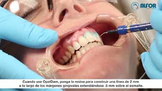 Opalustre Patient Testimonial  Removing decalcification spots from enamel [upl. by Rekyr]