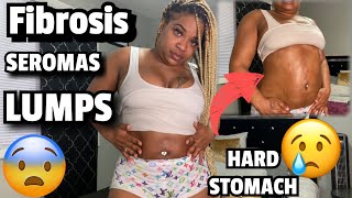 BBL JOURNEY  FIBROSIS AFTER LIPO SUCTION  LUMPS AND BUMPS  HARD STOMACH fibrosis bbl2023 bbl [upl. by Kendrick]