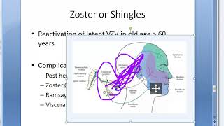 Microbiology 457 b Zoster Shingles VZV Varicella Zoster Virus ophthalmicus ramsay hunt acyclovir [upl. by Howe]