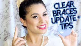 SMILE DIRECT CLUB 3 MONTH UPDATE  CLEAR BRACES EXPERIENCE amp TIPS [upl. by Rapp]