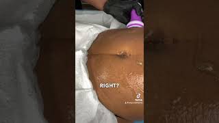 Body Sculpting Tip Lipo Cavitation Technique [upl. by Esor805]