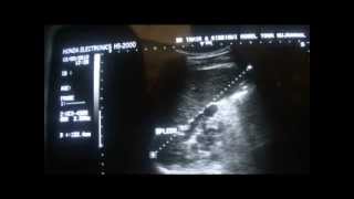 ultrasound SPLENIC HILAR REGION VARICES [upl. by Croteau]