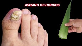 ¡ASESINO🔥de hongos en las uñas ¡INMEDIATAMENTE el mejor remedio natural 🌿 [upl. by Adnahcir]