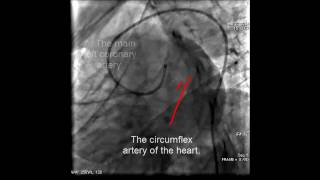 Coronary angiography anatomy [upl. by Sabanrab]