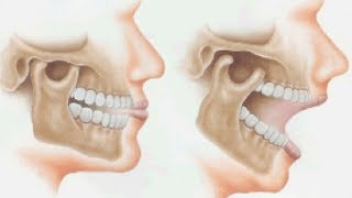 Orthotropic Treatment of Jaw JointTemporomandibular Disorder TMD by Dr Mike Mew [upl. by Nyladam]