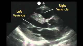 Cardiac Ultrasound  Parasternal Long Axis  Part 1  Sonosite Inc [upl. by Alleuol73]