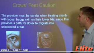 Botox Crows Feet Caution  Private Botox Training  Elite AMBT [upl. by Jariah]