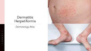 Dermatitis Herpetiformis [upl. by Jaala]