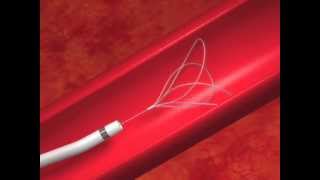 EN Snare® Endovascular Snare amp Catheter Animation [upl. by Saunder]