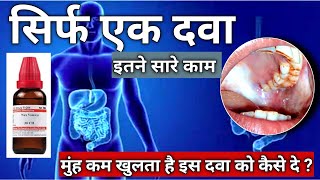 NUXVOMICA। submucous Fibrosis। मुंह के कम खुलने की रामबाण दवा। OSMF medicine। Homiopathy [upl. by Ing]