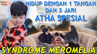 SYNDROME MEROMELIA  KURANGNYA ANGGOTA TUBUH PejuangNICU [upl. by Gariepy662]