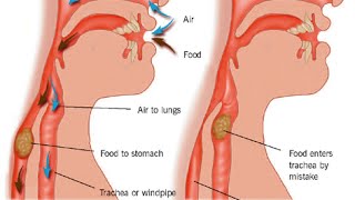 Aspiration Pneumonia [upl. by Llennor]