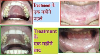 OSMF Early to Advance Stage Problem amppatient treatment resultOral Submucous Fibrosis and ulceration [upl. by Otrebtuc]