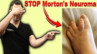 CURE Mortons Neuroma Metatarsalgia amp Ball of the Foot Pain FAST [upl. by Jaycee]