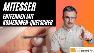 Mitesser entfernen mit Komedonenquetscher Wie geht das  Dr Kasten Hautmedizin in Mainz mitesser [upl. by Celio]