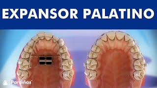 Ortodontia  Expansor Palatino e Aparelho Extra Bucal © [upl. by Krigsman]