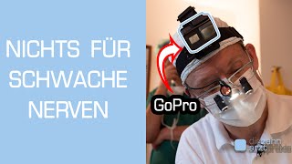 Zahnarzt filmt Weisheitszahn OP mit GoPro Vollnarkose [upl. by Janene]