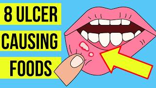 8 FOODS and DRINKS causing MOUTH ULCERS Canker sore  Plus treatment [upl. by Gen938]