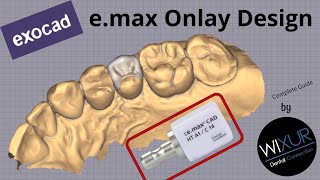 exocad emax Onlay Design [upl. by Waldos736]