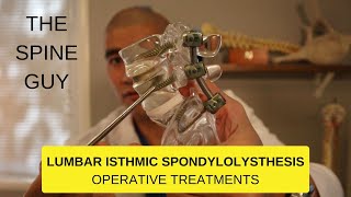 Lumbar Isthmic Spondylolisthesis  Part 3  Operative Treatments [upl. by Eelana]