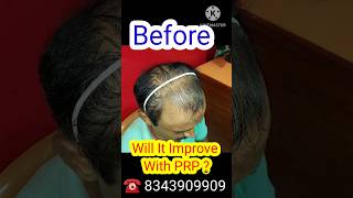 PRP HAIR LOSS TREATMENT BEFORE AND AFETR  YTSHORTS SHORTS [upl. by Tearle]