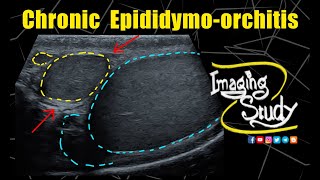 Chronic Epididymoorchitis  Ultrasound  Case 328 [upl. by Negam690]