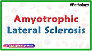 Amyotrophic Lateral Sclerosis Etiology Pathology Clinical maifestations Diagnosis and Treatment [upl. by Eeroc]