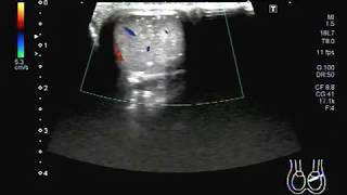 Ultrasound Video showing Testicular microlithiasis A rare case [upl. by Idaf164]