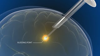 Endoscopic Evacuation of Intracerebral Hematoma [upl. by Uttica]