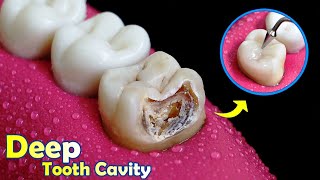 FANTASTIC Restoration Of Tooth Cavity By Root Canal And Composite Filling [upl. by Raf]