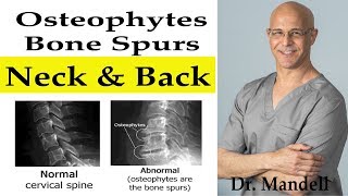 Do Bone SpursOsteophytes in Neck amp Back Go Away  Dr Alan Mandell DC [upl. by Flyn705]