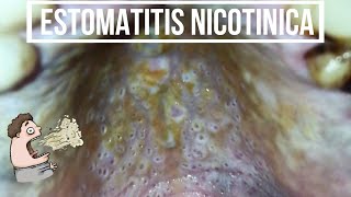 ESTOMATITIS NICOTÍNICA  Paladar del fumador Hiperqueratosis DE LA MUCOSA DEL PALADAR Odontología [upl. by Gwyneth495]