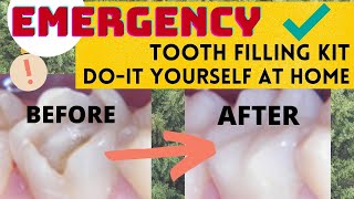 Emergency Tooth Filling Kit DIY at Home Easy Fix Solution [upl. by Atena]