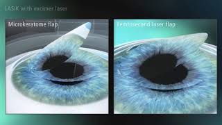 LASIK Treatment Animation Splitscreen [upl. by Debbi184]