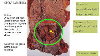 Pathology of Colorectal Cancer Adenocarcinoma [upl. by Cybill]