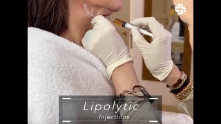 LIPOLYTIC INJECTIONS FOR FACIAL CONTOURING [upl. by Klump33]