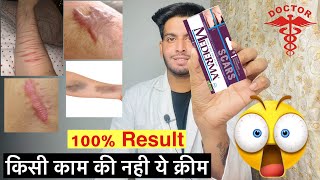 Mederma cream  Mederma advanced scar gel review  Mederma cream ke fayde  किसी काम की नही क्रीम 😱 [upl. by Eirrehs]