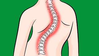 How to Fix Idiopathic Scoliosis Naturally [upl. by Anitirhc]