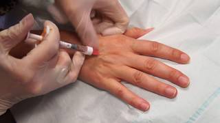 Rejuvenate Medical Spa Skin Boosters of Hand [upl. by Eldreda668]