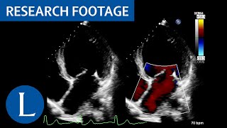 Dilated left ventricle with global hypokinesia LibmanSacks endocarditis 1 of 4 [upl. by Anu772]