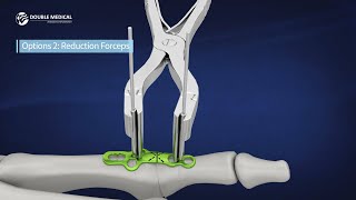 MTP Fusion Surgical Technique Animations 3 surgical Options Double Medical Marathon Fusion System [upl. by Israeli453]