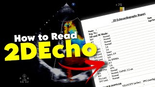 2DEcho  How to READ 2DEcho report  Echocardiography • Daily Cardiology [upl. by Ahsinan]