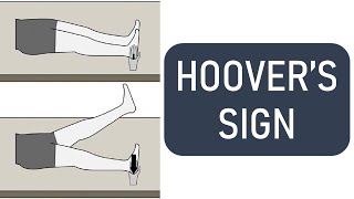 Hoovers Sign  Hoover Test [upl. by Erbas566]