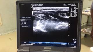 Ultrasound Guided Supraclavicular Block [upl. by Domph]