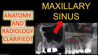 ALL Maxillary Sinus Anatomy 3D CBCT Mucosal Thickening in x ray OPG easy maxillary sinusitis lecture [upl. by Zysk487]