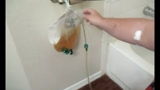 Care of Urinary Catheter  Emptying of Urine Bag for Bedbound Person [upl. by Niad]