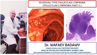 DUODENAL TYPE FOLLICULAR LYMPHOMA BY DR WAFAEY BADAWY [upl. by Violet]