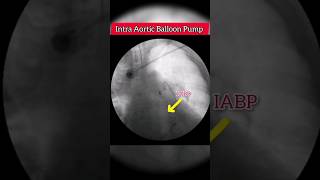 IABP Pulmonary Angiogram Showing Extensive Bilateral Pulmonary Embolism cardiology [upl. by Secnarfyram]
