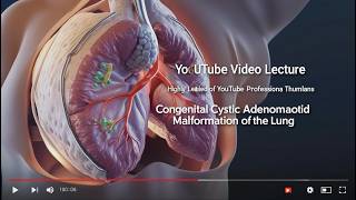 Fetal Anomalies Congenital Cystic Adenomatoid Malformation CCAM of The Lung [upl. by Gifferd]